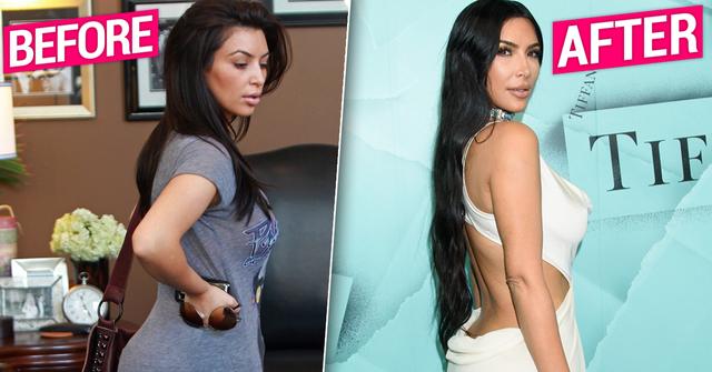 Kim Kardashian Butt Implants