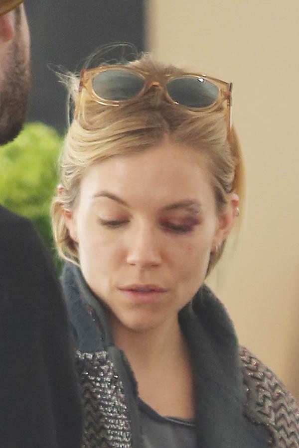 Sienna Miller Black Eye Photos