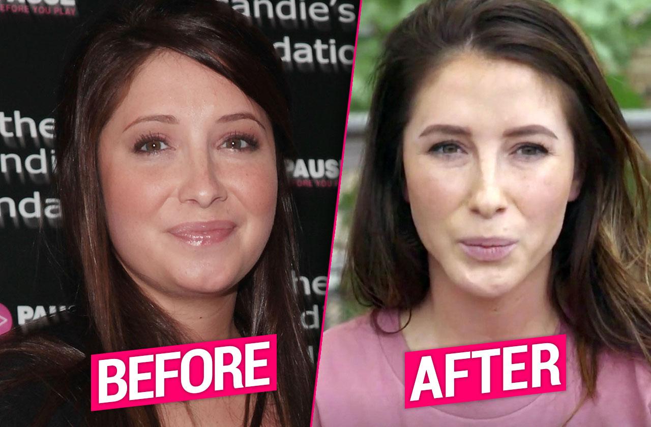 Bristol palin plastic surgery liposuction botox teen mom og