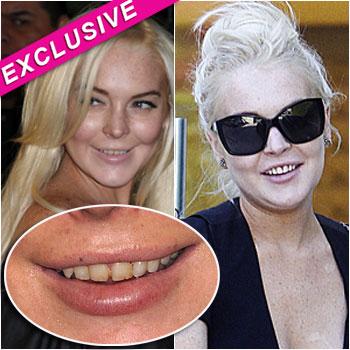 Lindsay Lohan Teeth Dentist Inf Fame 
