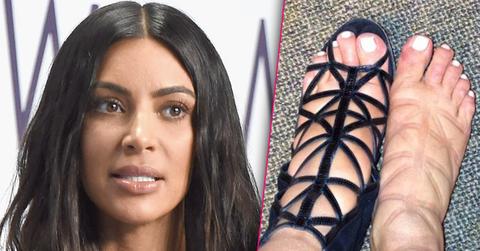kim kardashian swollen feet cankles hammer toe surgery