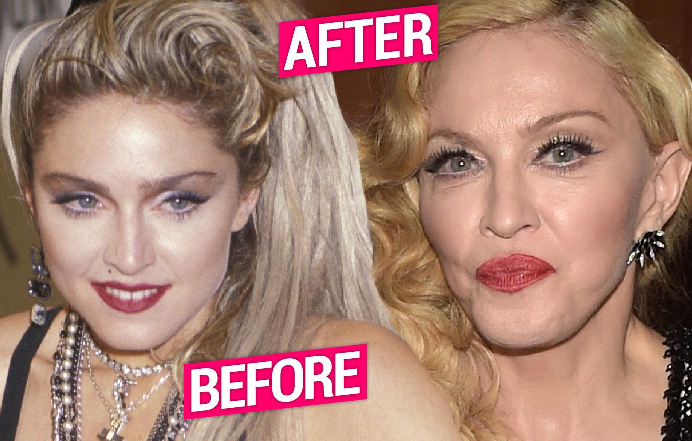 Exclusive Madonna Plastic Surgery Secrets Revealed Pp  