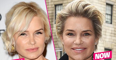 Yolanda Foster Plastic Surgery Botox Wrinkles