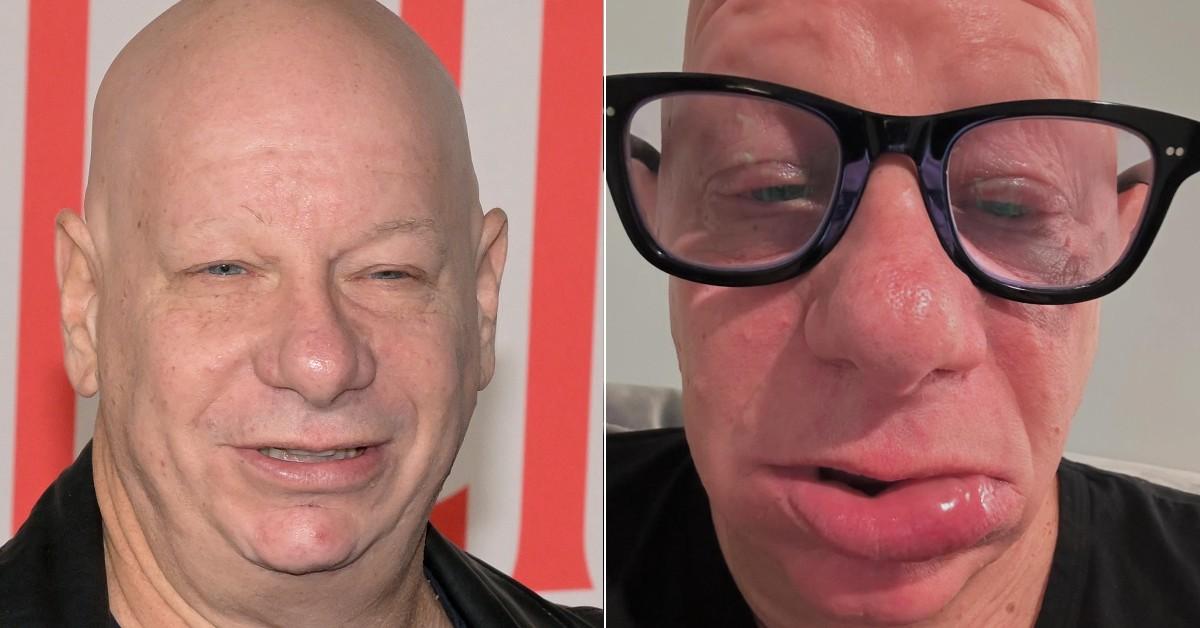 See the Shocking Pictures: Jeff Ross Left Looking Unrecognizable As He's Hospitalized for Severe Allergic Reaction to a Surprising Food Item