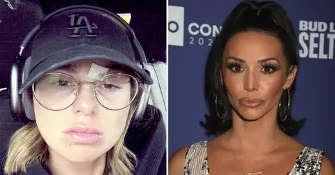 raquel scheana bruise pp