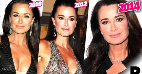 Kyle Richards Plastic Surgery