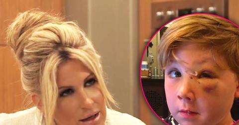 kim zolciak son kash biermann dog bite plastic surgery plays animals video