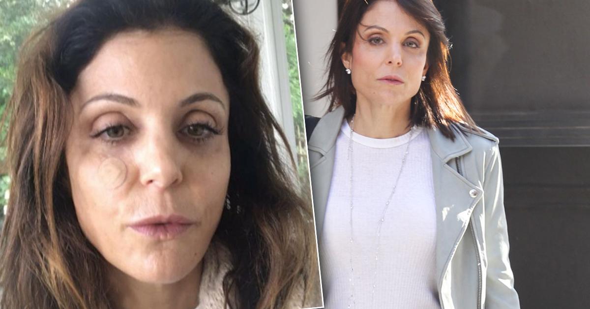 Bethenny Frankel Tested For Skin Cancer After Removing Growth