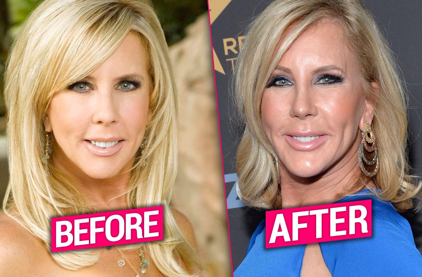 vicki gunvalson plastic surgery botox fillers rhoc pics