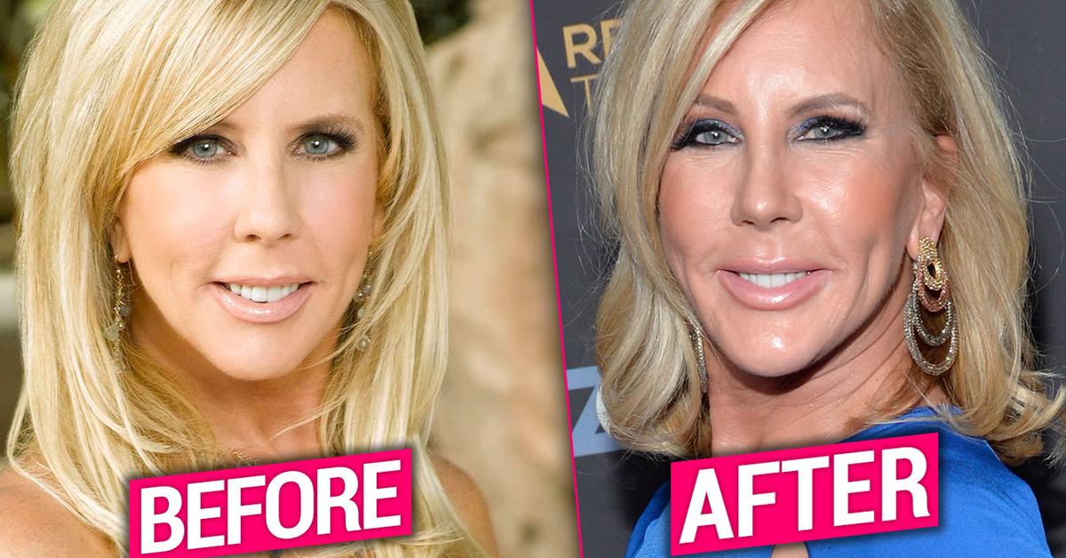 [PICS] ‘RHOC’ Vet Vicki Gunvalson’s Plastic Surgery Transformation Exposed