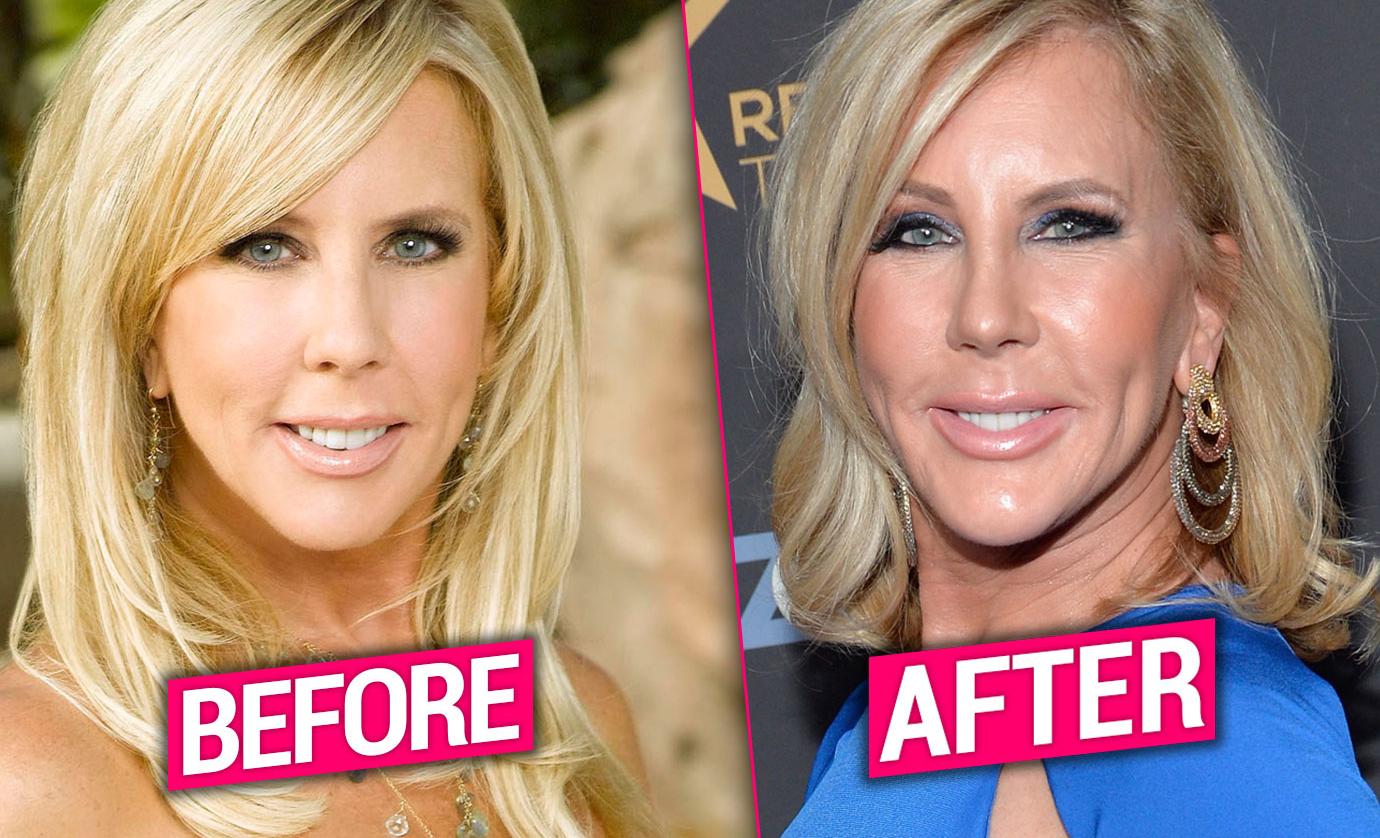 [PICS] ‘RHOC’ Vet Vicki Gunvalson’s Plastic Surgery Transformation Exposed