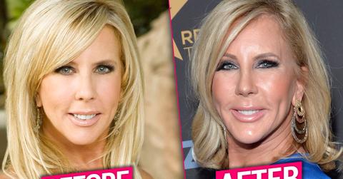 vicki gunvalson plastic surgery botox fillers rhoc pics