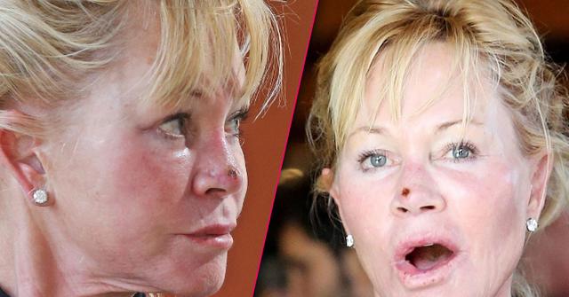 Melanie Griffith Steps Out With Scab On Her Nose