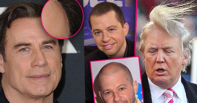  Celebrities Who Are Covering Up Their Bald Spots & Receding Hairlines Bildidee 