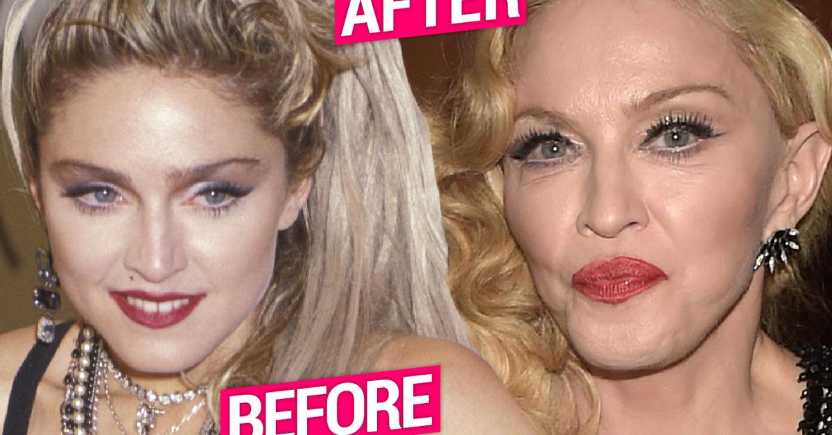 Madonna Plastic Surgery Secrets Revealed