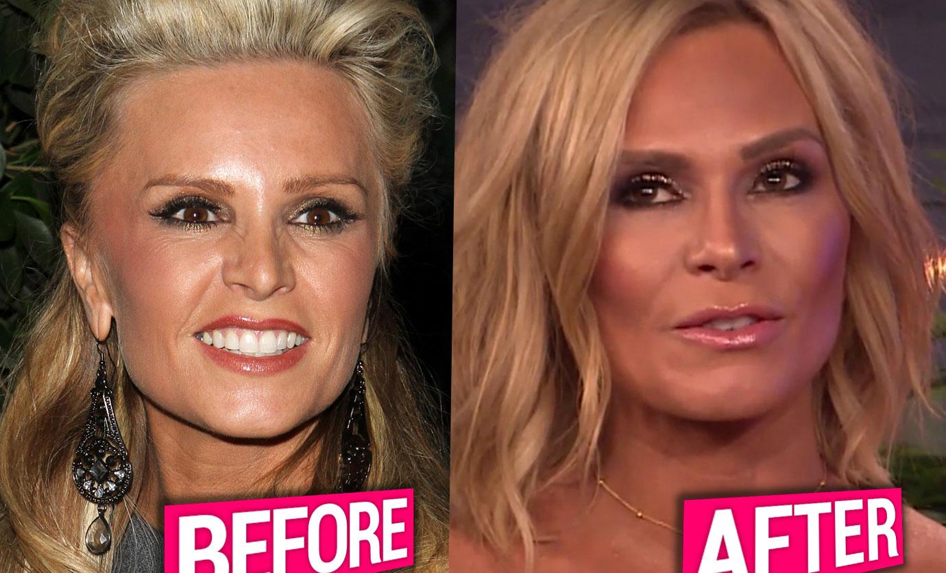 [PICS] Tamra Judge's Plastic Surgery Confession!