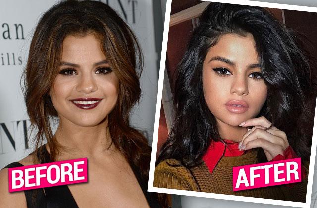 //Selena Gomez Lip Injections Plastic Surgery