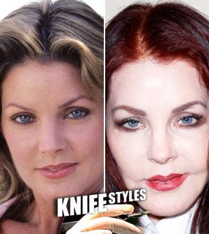 Priscilla Presley Dramatic Plasic Surgery Transformation