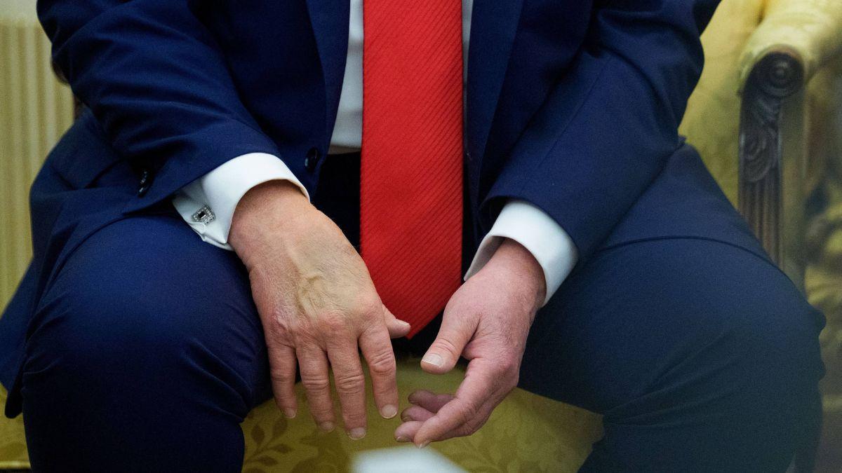 Photo of Donald Trump's bruised hand