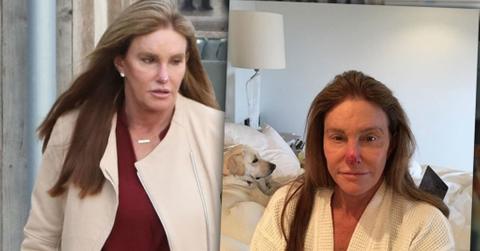 //caityln jenner bloody nose pp