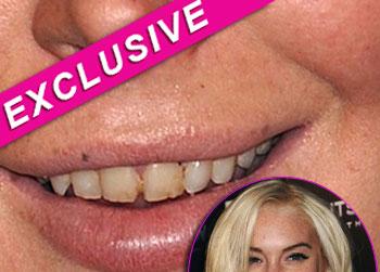 //lindsay lohan teeth dentist inf