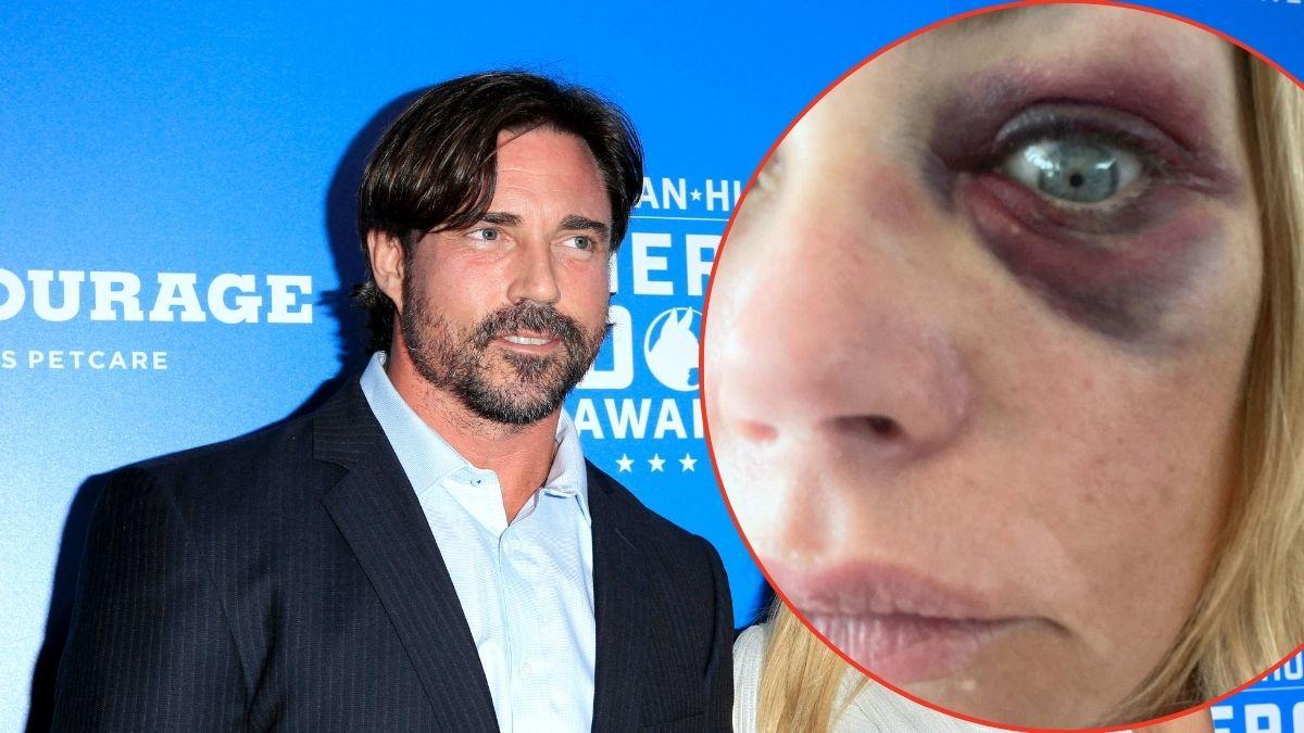 Phypers claimed Richards blamed her black eye on a drunken fall while climbing stairs.