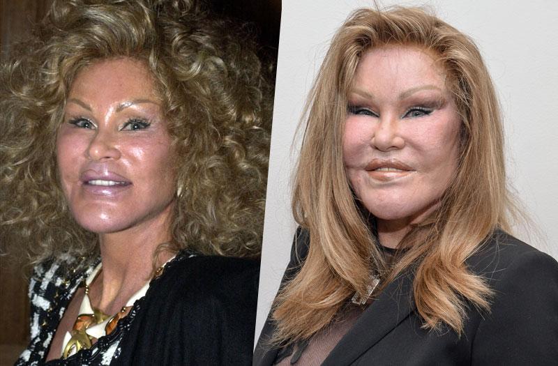 Facelifts! Botox! Stars With Freaky Faces After Botched Plastic Surgery