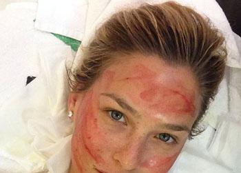 Bar Rafaele get the vampire facial