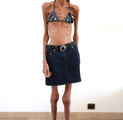 The World's Thinnest Woman Warns Girls About Extreme Dieting