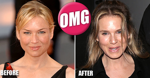 //renee_zellweger_before_and_after_wide