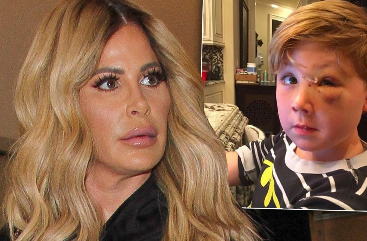 kim zolciak son kash biermann dog bite recovery pic