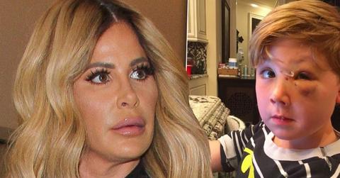 kim zolciak son kash biermann dog bite recovery pic