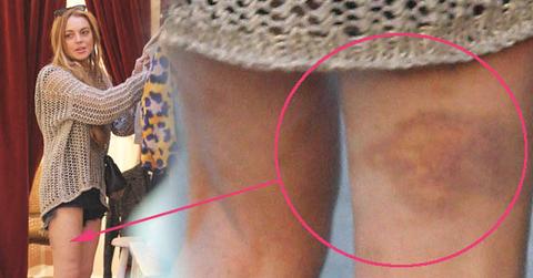 //lilo bruise