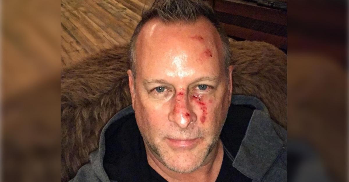 dave coulier shares shocking bloody photo talks sobriety