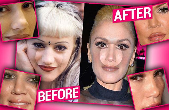 celebrity nose before and after