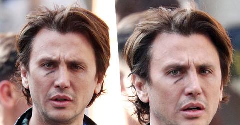 //jonathan cheban plastic surgery black eye pp