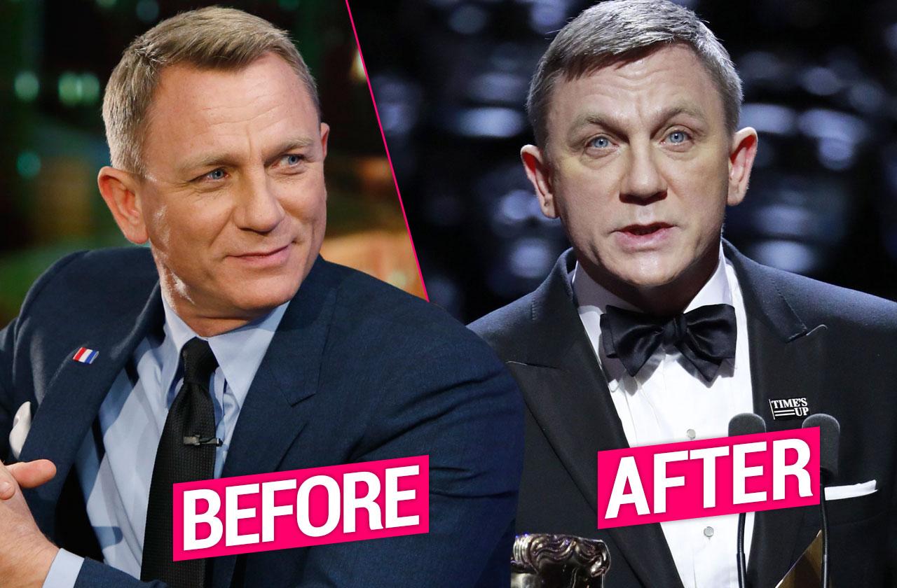 //Daniel Craig Plastic Surgery Face Photos  pp