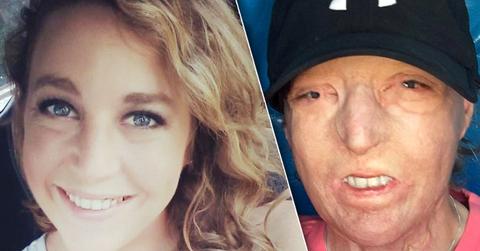 Horror Husband Leaves Wife After Suffering Fourth Degree Burns To Her Face