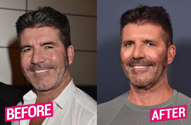 Simon Cowell Plastic Surgery Makeover Exposed By Top Docs