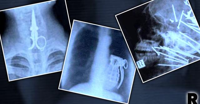 Inside Story! Weird Objects & Horrifying Injuries Caught On X-Ray!