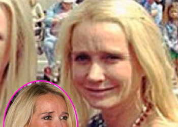 //kim richards nose job