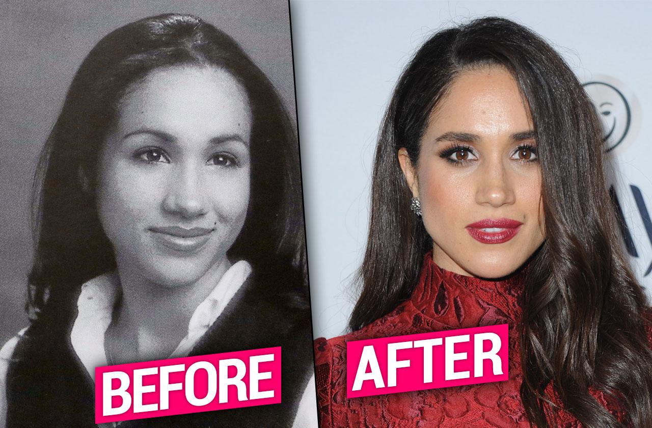 Meghan markle plastic deals surgery new look