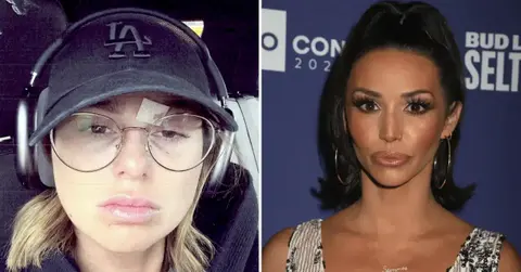 raquel scheana bruise pp