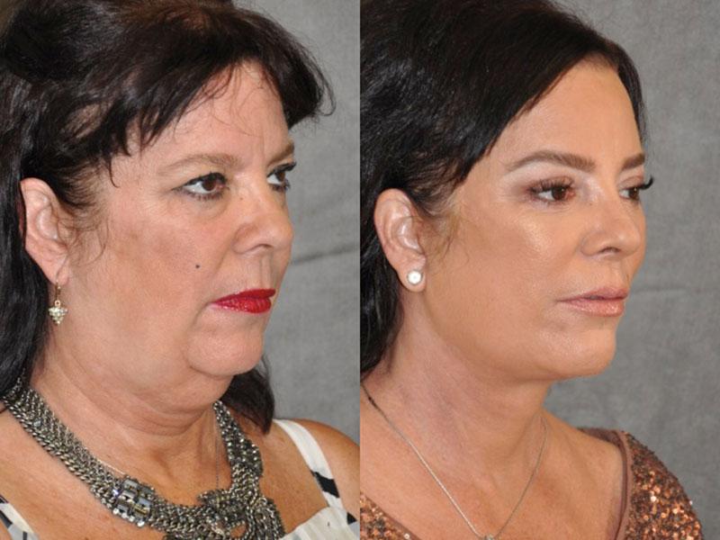 Kris Jenner Sister Karen Houghton Plastic Surgery Facelift Pics 05 