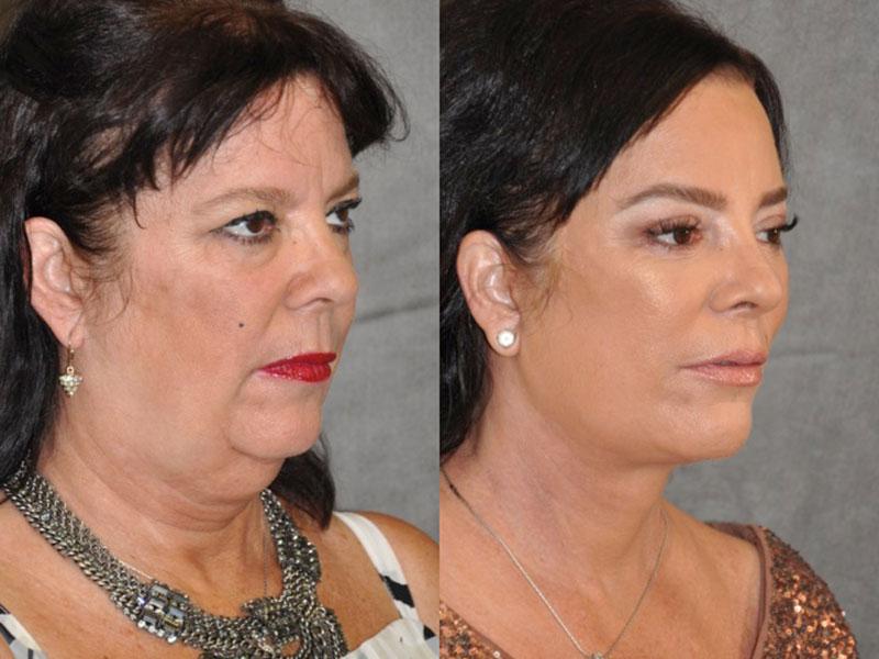 Just Like Kris! Jenner's Sister Goes Under The Knife To Look Like