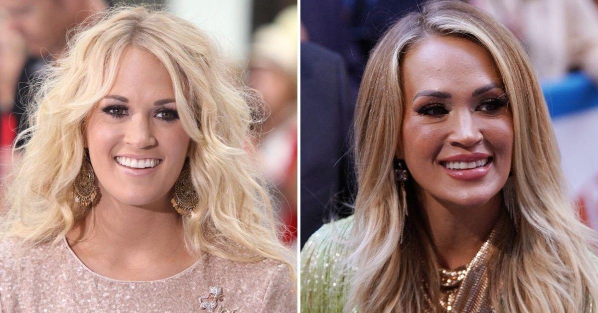 Carrie's Face Fail Country Superstar Has ‘Caught the Cosmetic Surgery Bug’