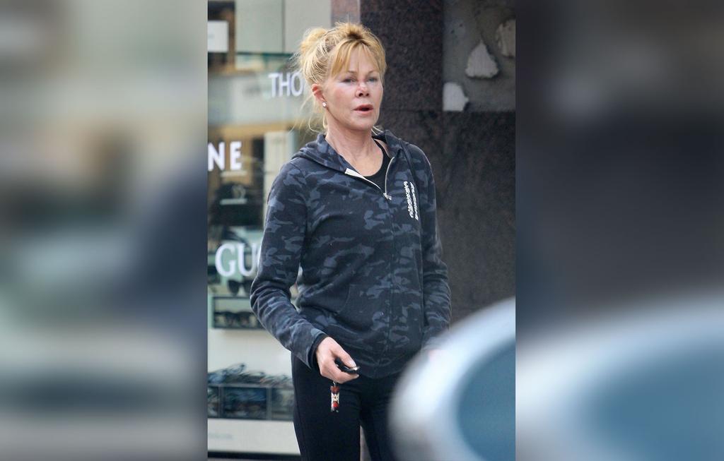 Melanie Griffith Wears Nose Bandage After Skin Cancer Treatment(02)