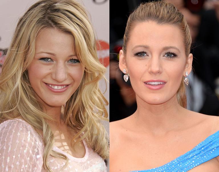 Secret Celebrity Nose Jobs