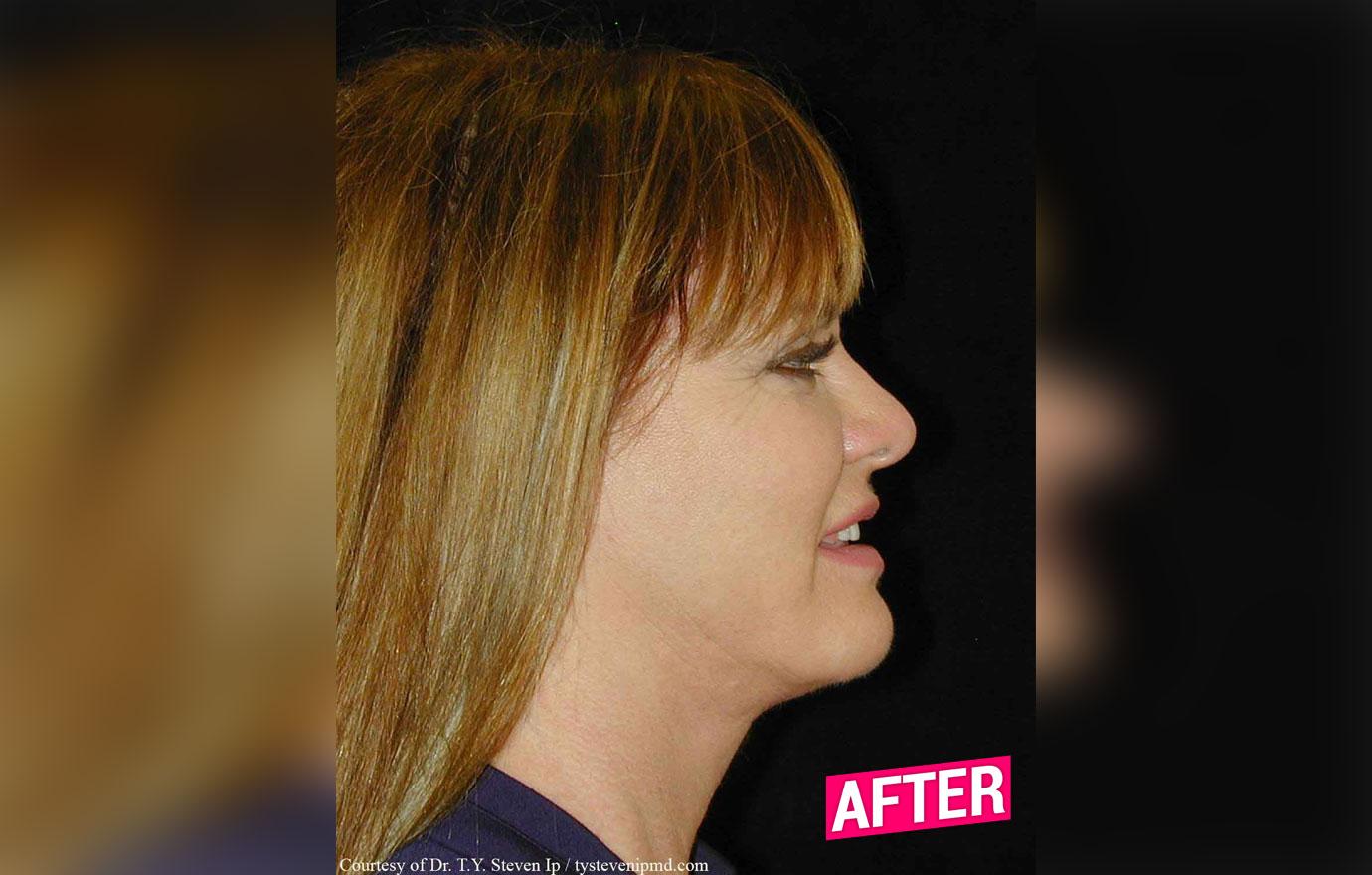 //rhoc Jeana Keough plastic surgery makeover