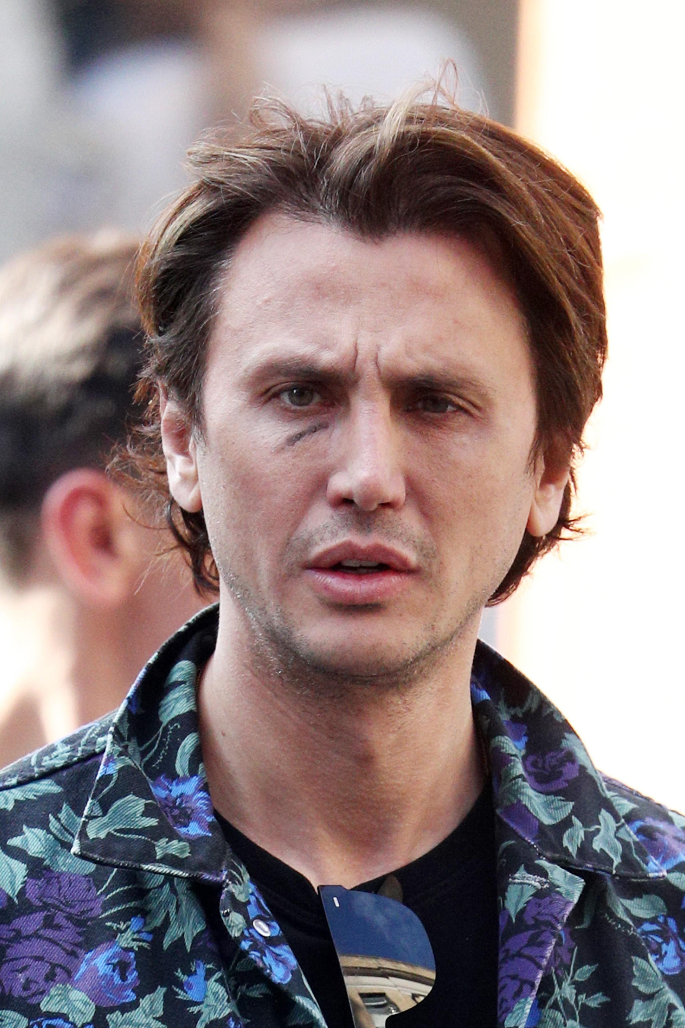 Ouch Jonathan Cheban Caught With Nasty Bruise Under His Eye. 